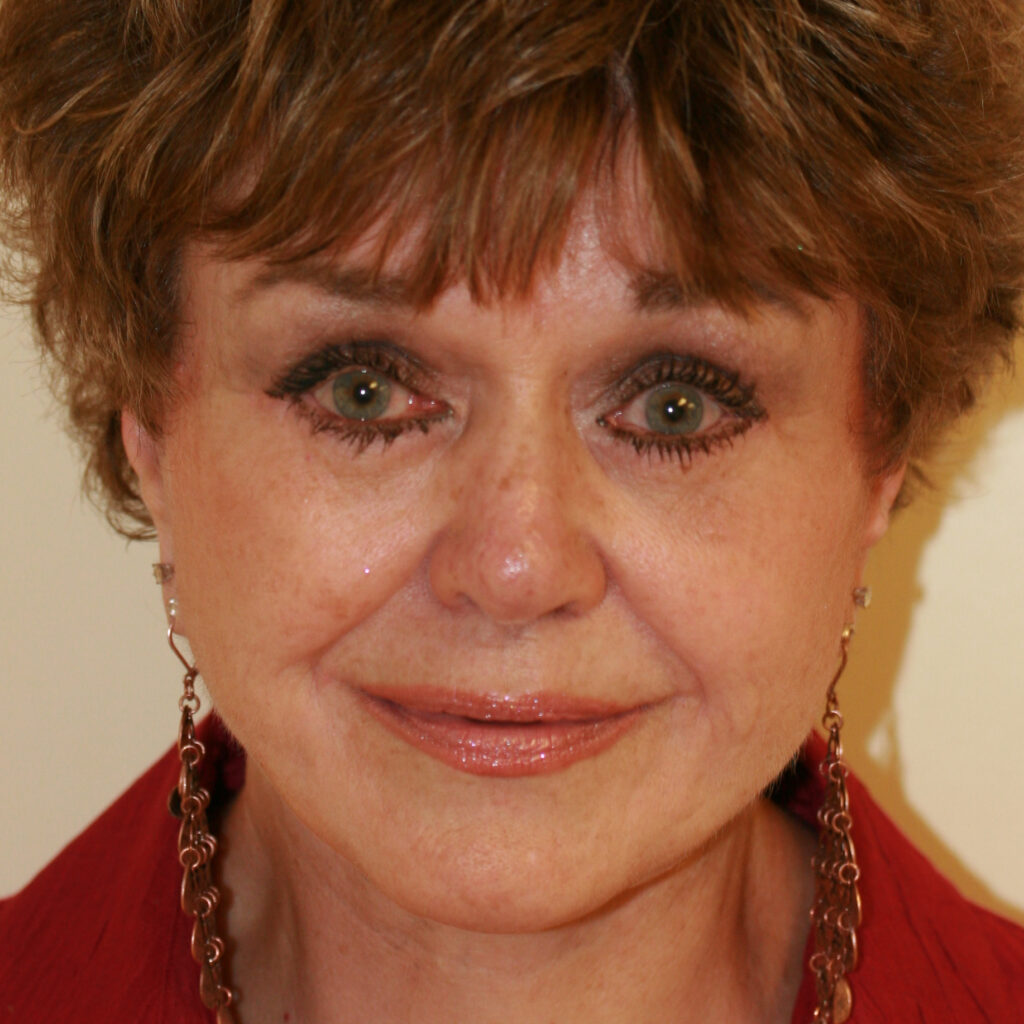 facelift3after
