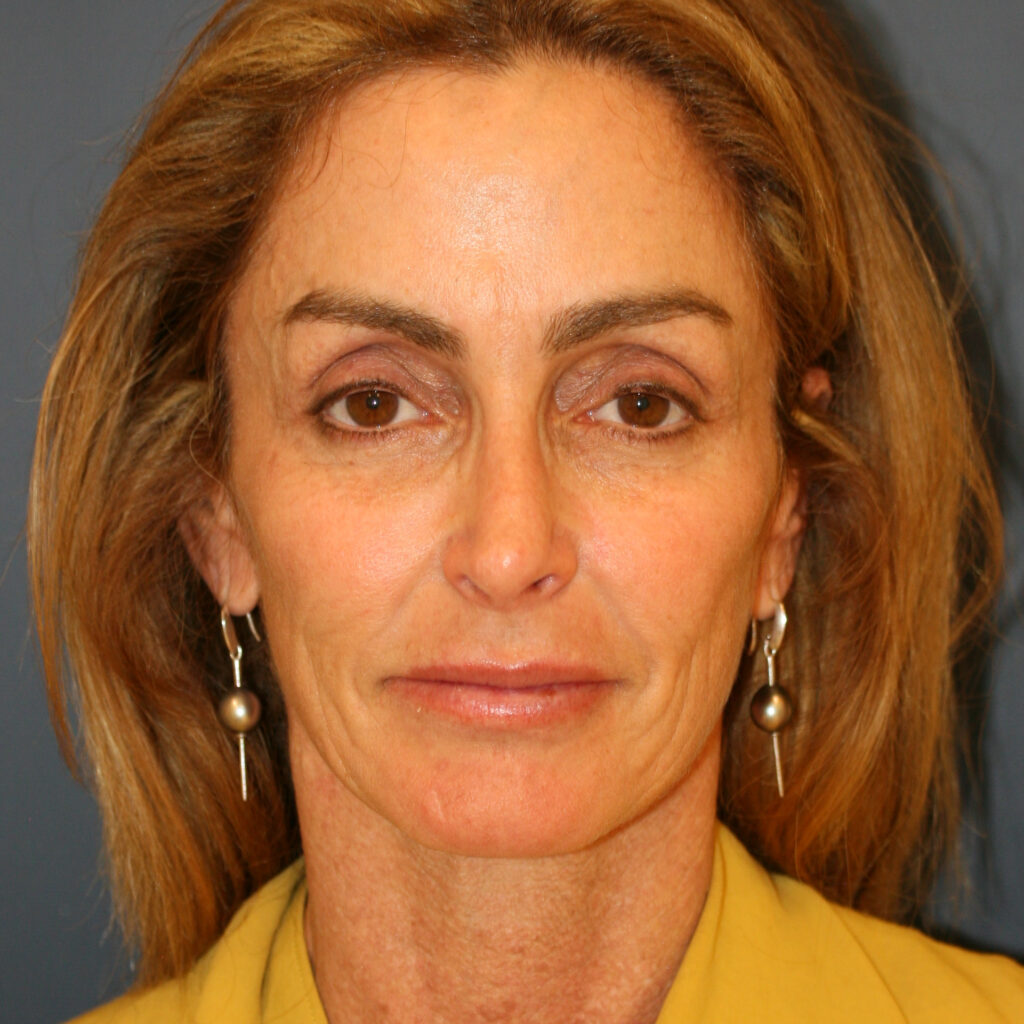 facelift4before