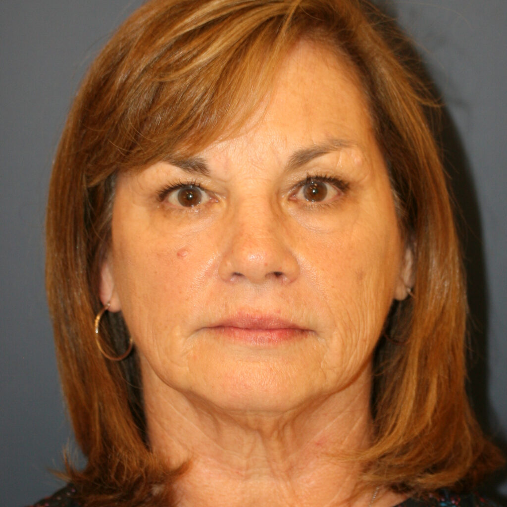 facelift6before