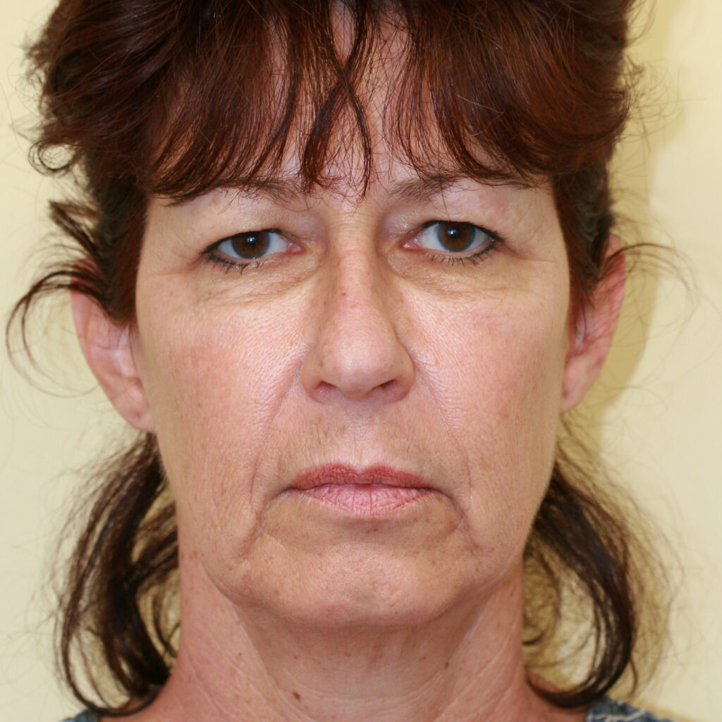 facelift7before