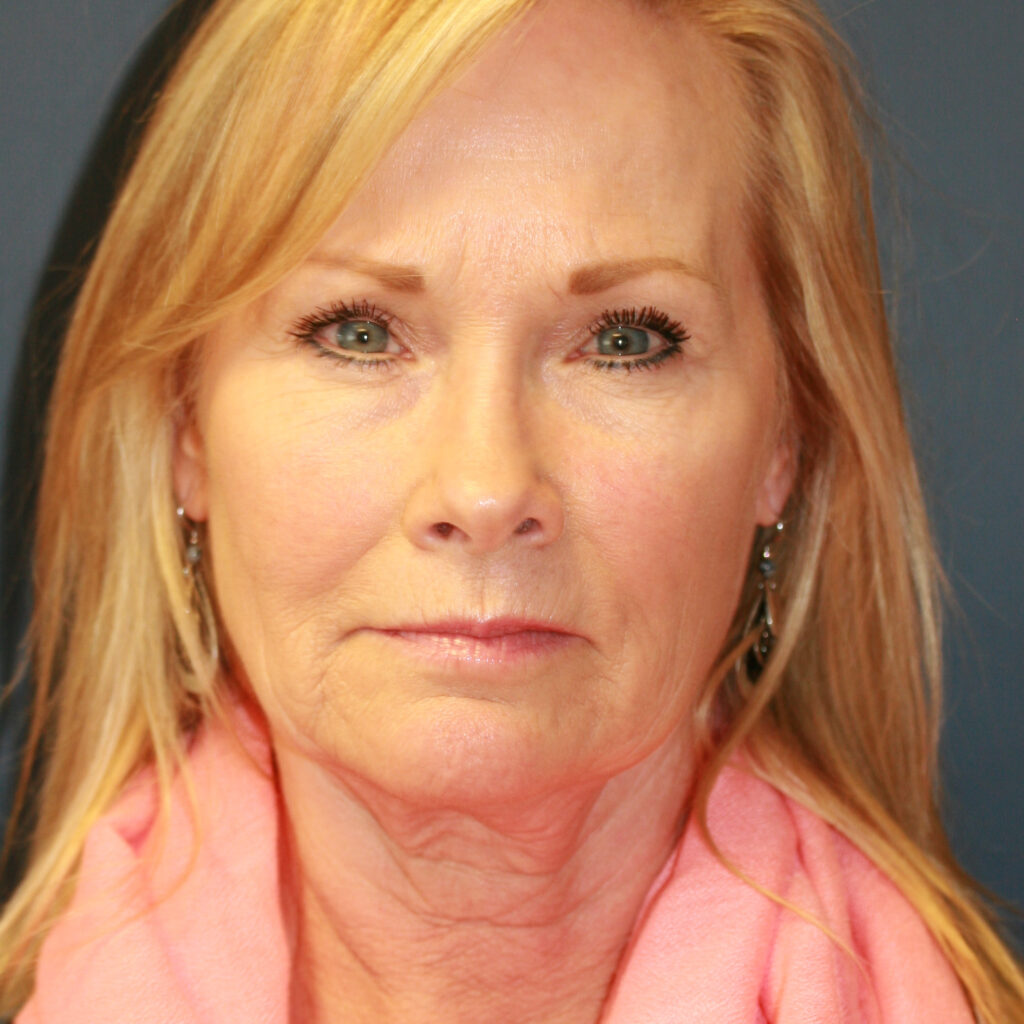 facelift8before