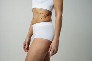 tummy tuck