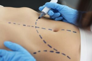 Body Procedures