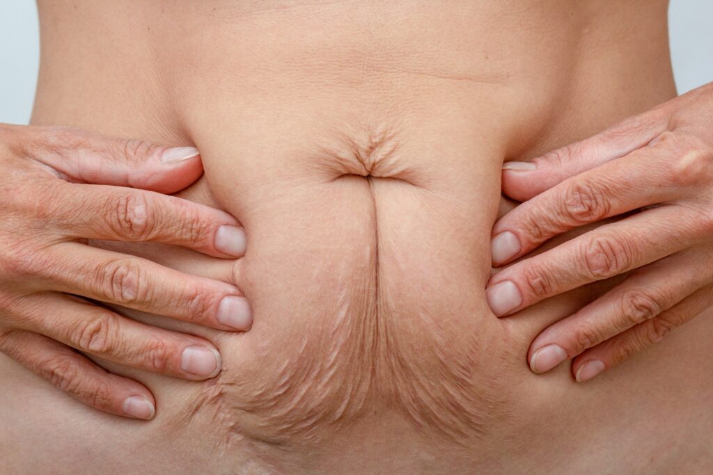 Postpartum Tummy Tuck