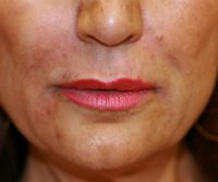 Juvederm San Diego Plastic Surgery post