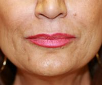 Juvederm pre
