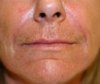 filler after front