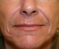 filler before front