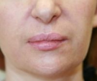juvederm filler before