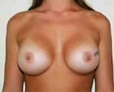 Feel Beautiful - Breast Augmentation Case 2 - After Photo