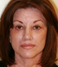 Feel Beautiful - Browlift San Diego Case 10 - After Photo