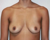 Feel Beautiful - Breast Augmentation Case 1 - Before Photo