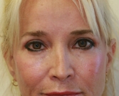 Feel Beautiful - Eyelid Surgery San Diego Case 38 - After Photo