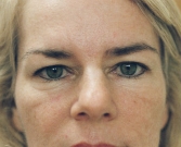 Feel Beautiful - Eyelid Surgery San Diego Case 40 - Before Photo