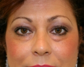 Feel Beautiful - Eyelid Surgery San Diego Case 44 - Before Photo