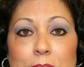 Feel Beautiful - Eyelid Surgery San Diego Case 44 - After Photo