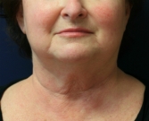 Feel Beautiful - Necklift San Diego Case 19 - Before Photo