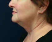 Feel Beautiful - Necklift San Diego Case 19 - Before Photo