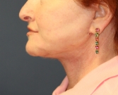 Feel Beautiful - Necklift San Diego Case 19 - After Photo