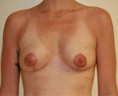 Feel Beautiful - Breast Lift Case 3 - After Photo