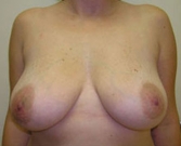 Feel Beautiful - Breast Lift Case 4 - Before Photo