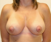 Feel Beautiful - Breast Lift Case 5 - After Photo