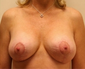 Feel Beautiful - Breast Lift Case 6 - After Photo
