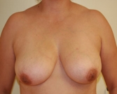 Feel Beautiful - Breast Lift Case 8 - Before Photo