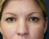 Feel Beautiful - Eyelid Surgery San Diego Case 49 - Before Photo