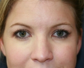Feel Beautiful - Eyelid Surgery San Diego Case 49 - After Photo