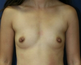 Feel Beautiful - Breast Implants San Diego, Case 65 - Before Photo