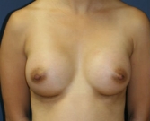 Feel Beautiful - Breast Implants San Diego, Case 65 - After Photo