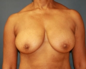 Feel Beautiful - Breast Lift San Diego Case 18 - Before Photo