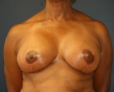 Feel Beautiful - Breast Lift San Diego Case 18 - After Photo