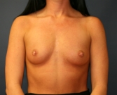 Feel Beautiful - Breast Augmentation San Diego Case 67 - Before Photo
