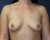 Feel Beautiful - Breast Augmentation Lift San Diego 14 - Before Photo