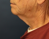Feel Beautiful - Necklift San Diego Case 20 - Before Photo