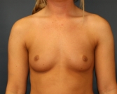 Feel Beautiful - Breast Augmentation San Diego Case 68 - Before Photo