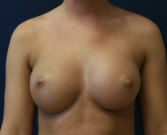 Feel Beautiful - Breast Augmentation San Diego Case 68 - After Photo
