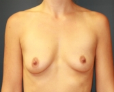 Feel Beautiful - Breast Augmentation San Diego Case 69 - Before Photo
