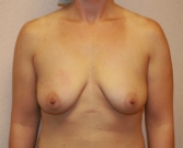 Feel Beautiful - Breast Augmentation San Diego Case 70 - Before Photo