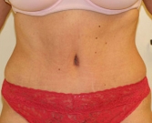 Feel Beautiful - Tummy Tuck Case 1 - After Photo