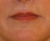 Feel Beautiful - Laser skin treatment San Diego case 4 - After Photo