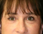 Feel Beautiful - Laser skin treatment San Diego case 5 - After Photo