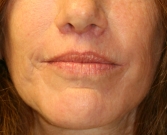 Feel Beautiful - Laser skin treatment San Diego case 7 - After Photo