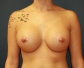 Feel Beautiful - Breast Augmentation San Diego Case 71 - After Photo