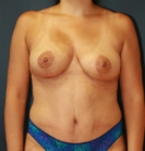 Feel Beautiful - Mommy Makeover San Diego, Case 13 - After Photo