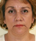 Feel Beautiful - Necklift Case 3 - Before Photo