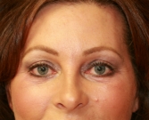 Feel Beautiful - Eyelid Surgery San Diego Case 50 - After Photo