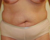 Feel Beautiful - Tummy Tuck Case 17 - Before Photo